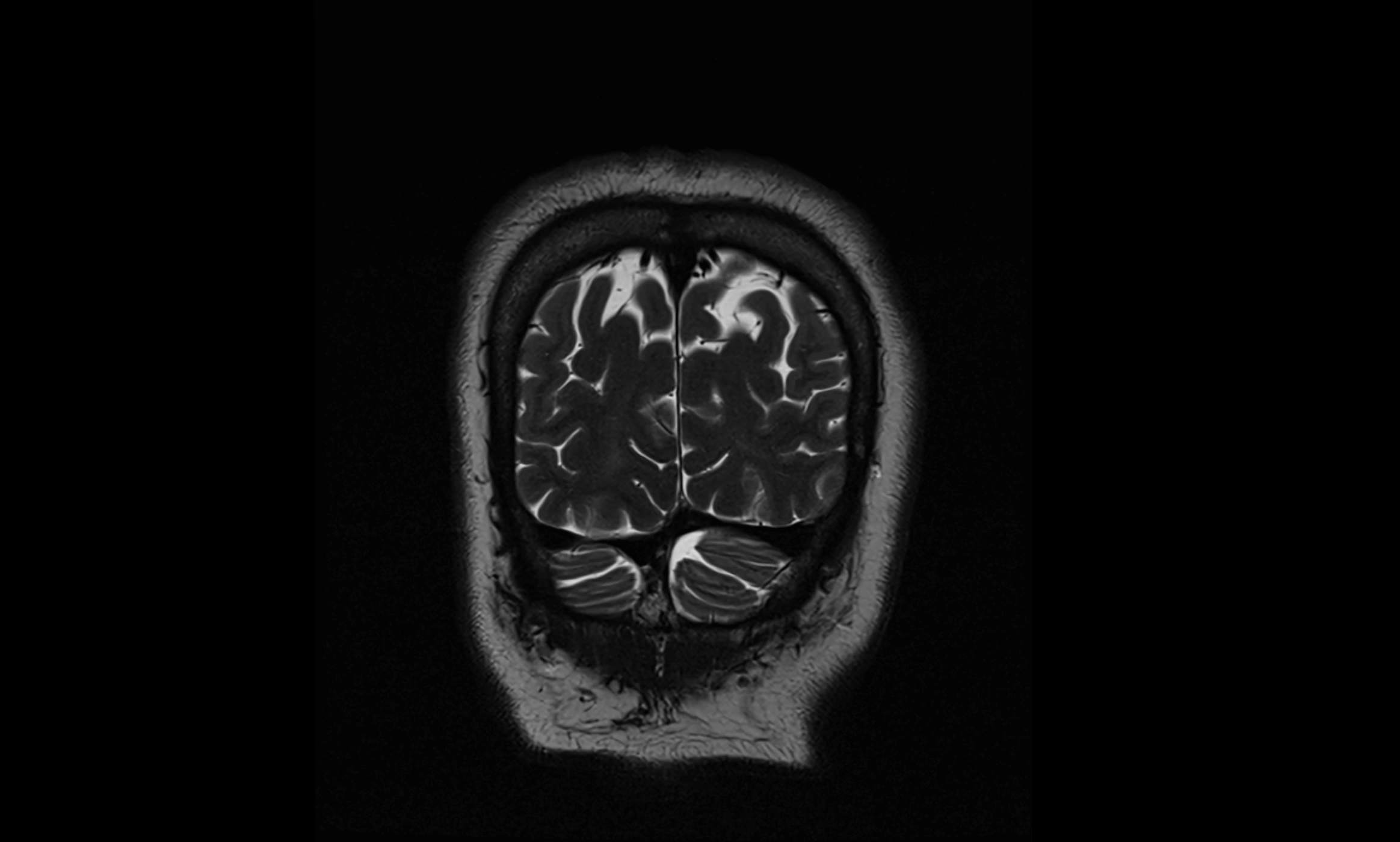 Brain cisterns  and ventricles coronal anatomy 3T MRI image-img-00001-00058.webp